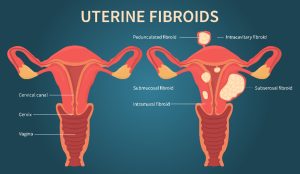 uterine fibroid embolization in Arizona